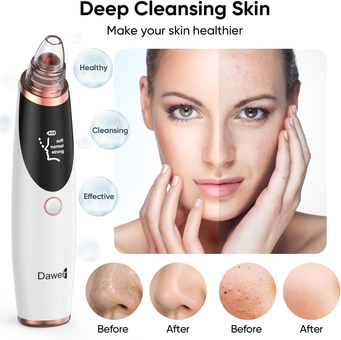 Blackhead Remover Pore Vacuum - Facial Pore Cleanser with 3 Suction Levels & 5 Tips | USB Rechargeable, White