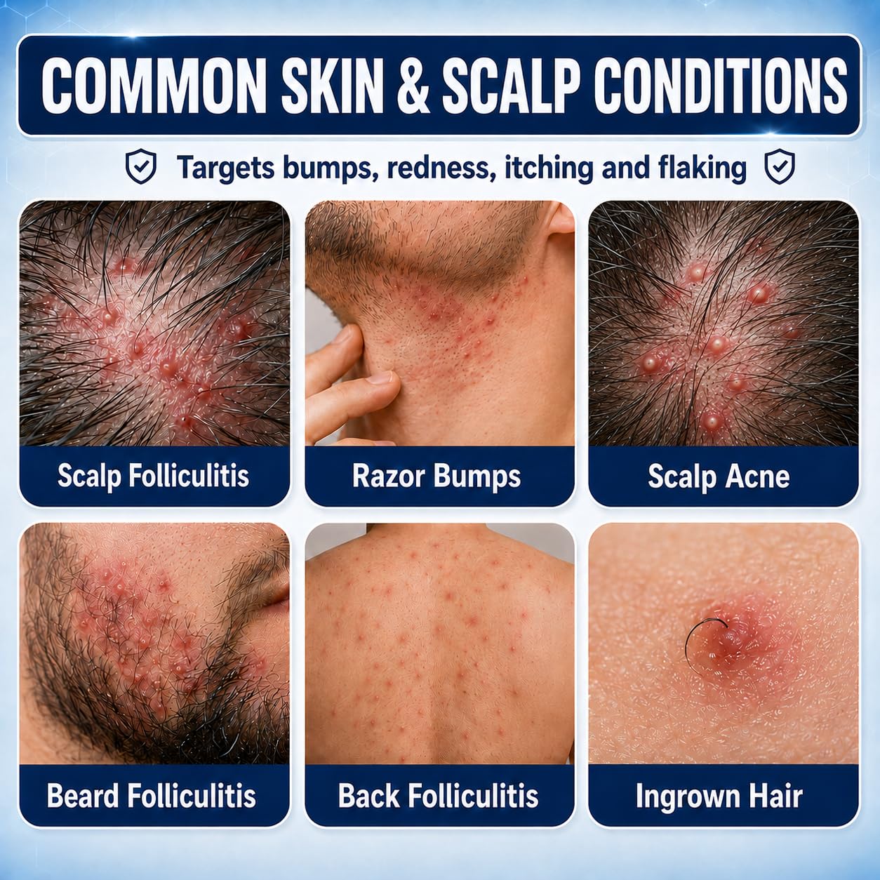 Razor Bumps & Ingrown Hair Folliculitis Treatment Cream – 5% Benzoyl Peroxide for Scalp Bumps & Body Acne – Fast-Acting Relief for Shaving Irritation, Redness & Bumps with Tea Tree & Centella, 3.53 oz