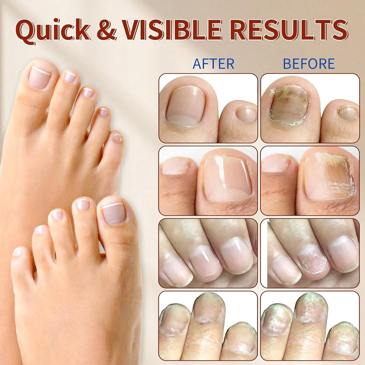 Fungal Nail Patches - 4 Pack Toenail Repair Patches for Discolored & Damaged Nails | 84 Count, 9-Hour Adhesion