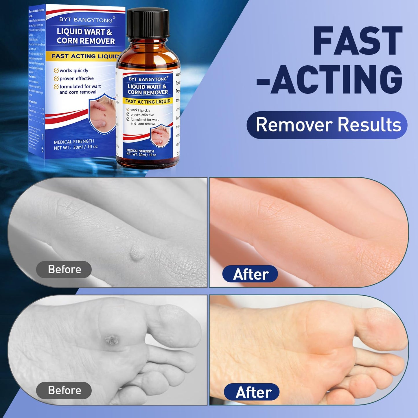 BYT BANGYTONG Wart Remover Liquid - Gentle Formula for Plantar Warts, Common & Corn on Feet, Hands and Other External Areas - 17% Salicylic Acid - NET WT: 30ml/ 1fl oz