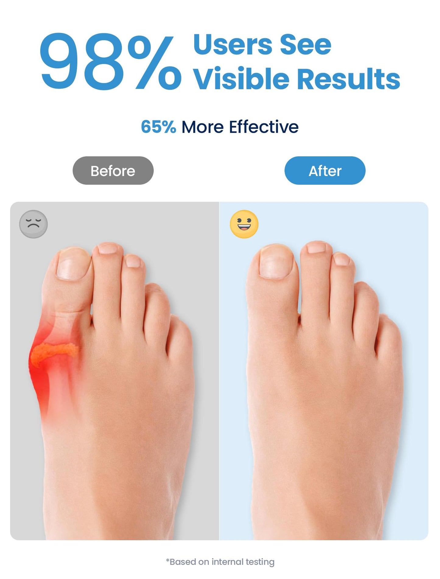 Toe Separators for Women & Men, Gel Toe Spacers, Bunion Corrector for Big Toe Alignment, Reusable, 4 Pack (White)