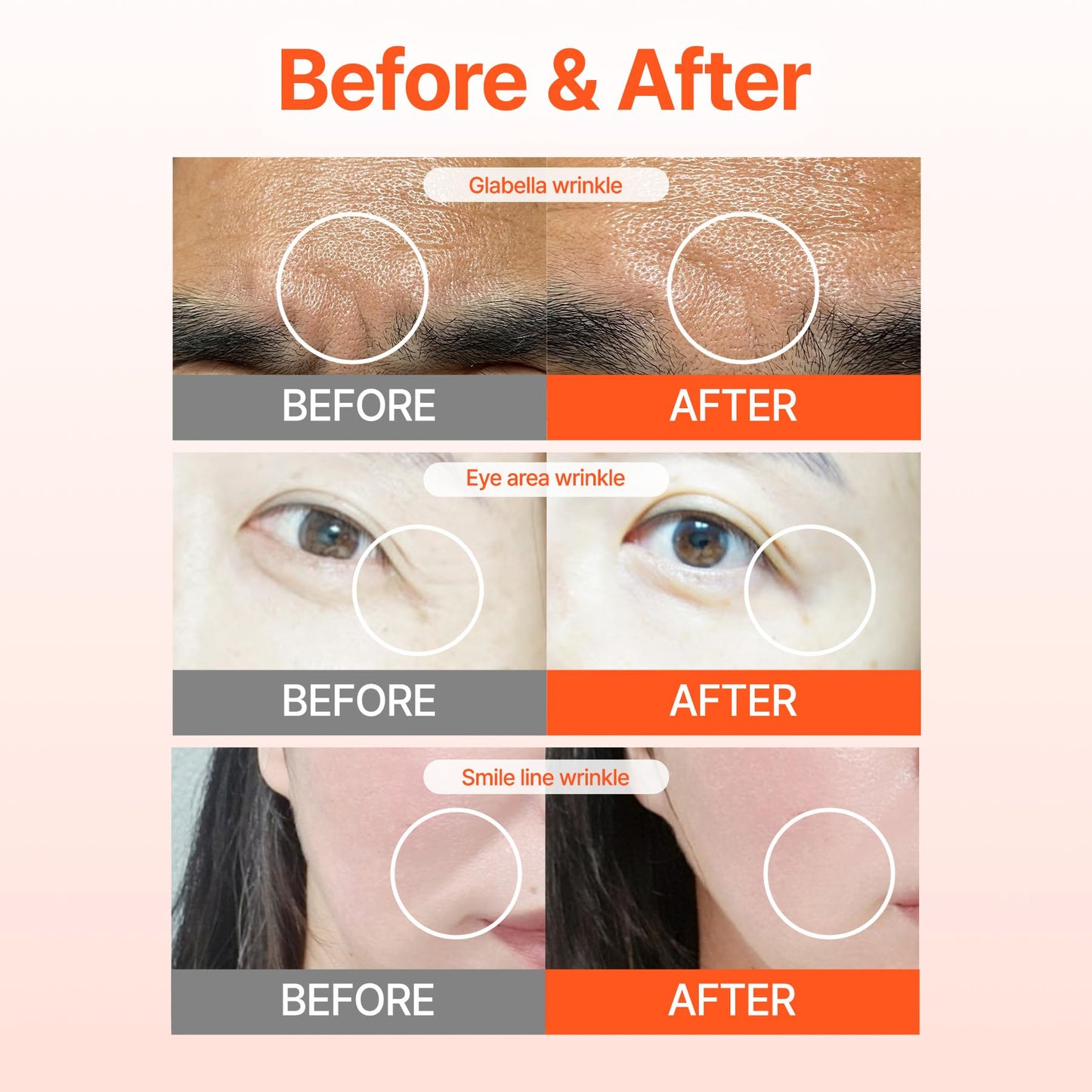 Wrinkle Patches ACROPASS RETI-RN Microcone, Deep Wrinkle, PDRN 10,000 ppm, Retinol 3,300 IU/g, Hyaluronic Acid, Anti-Aging (Slim Type, 6 Count)