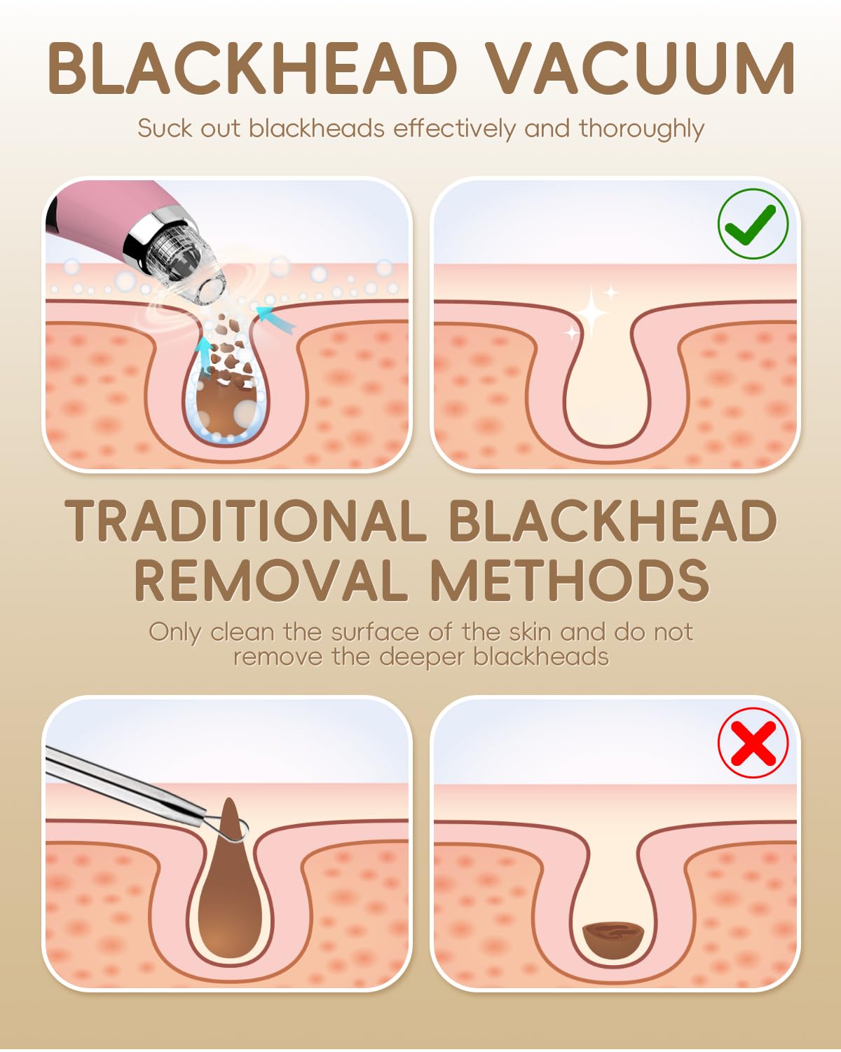 Pore Vacuum Blackhead Remover - Pore Extractor with 5 Attachments & 3 Suction Levels - Blackhead Remover Tools for Women and Men (Pink)