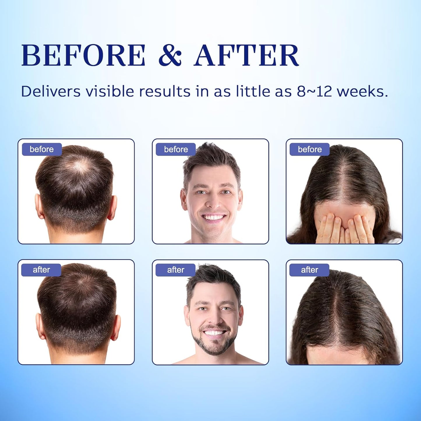 5% Minoxidil Hair Growth Treatment for Men & Women - Regrowth Spray | 2-Pack