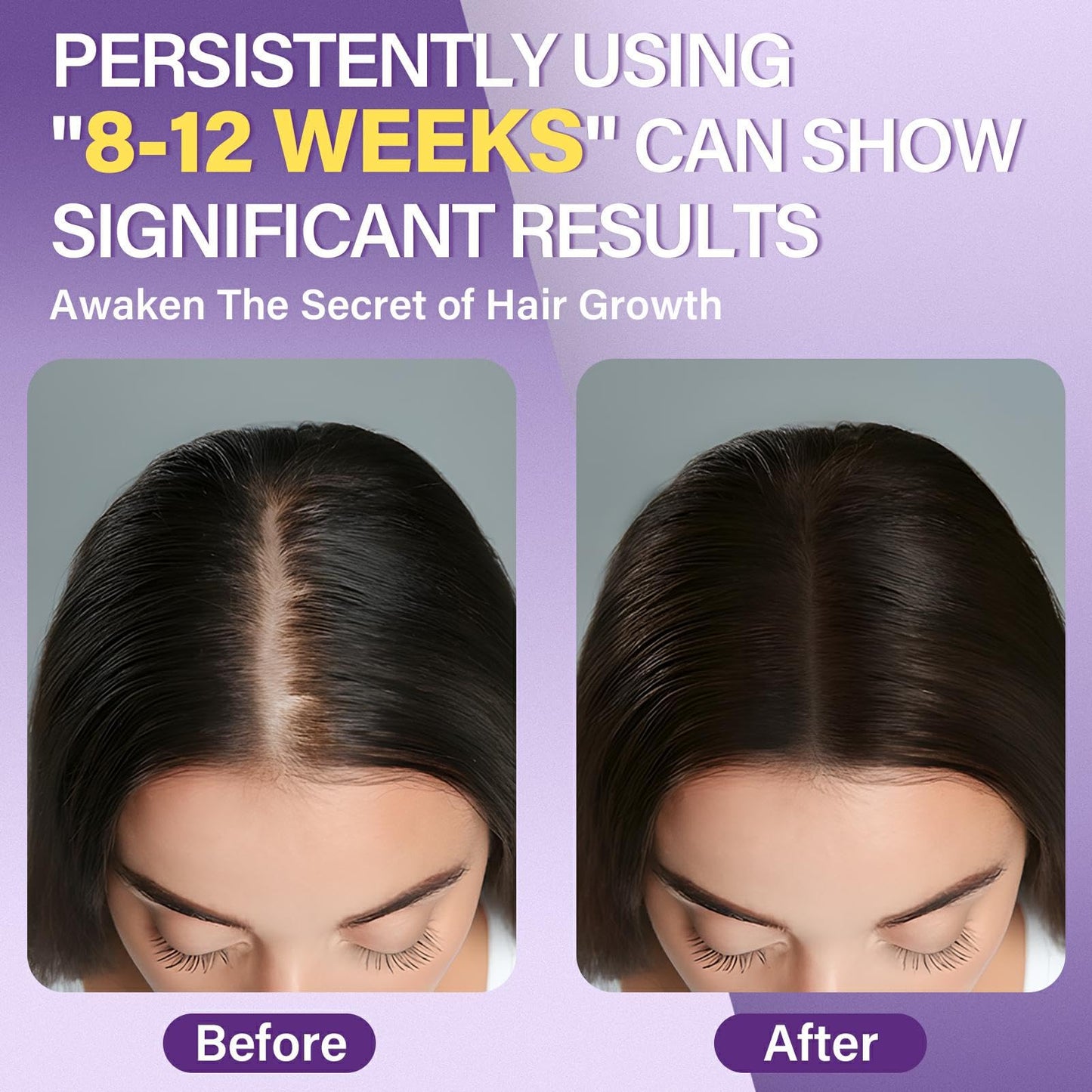 5% Minoxidil Foam for Women Hair