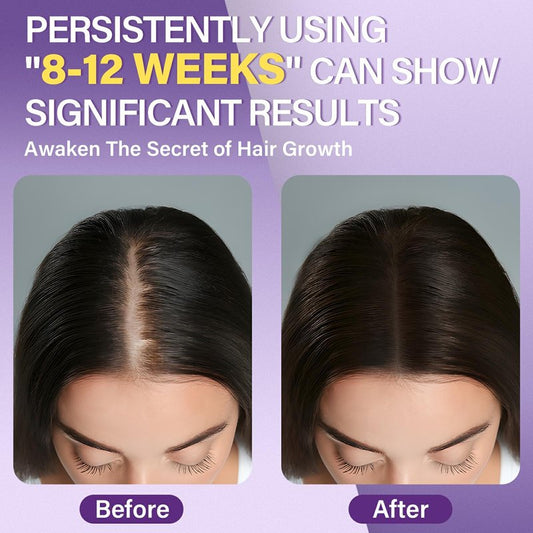 5% Minoxidil Foam for Women Hair