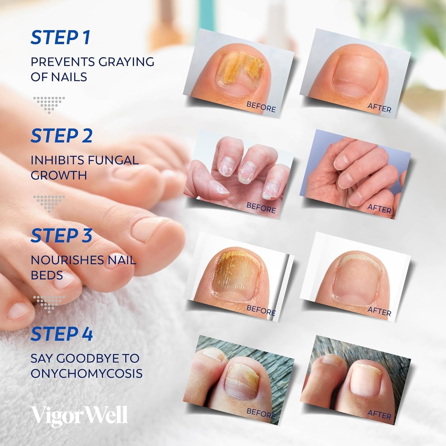 Toenail Fungus Treatment - Extra Strength Liquid & Nighttime Patches | 32 Patches + 15ml Set