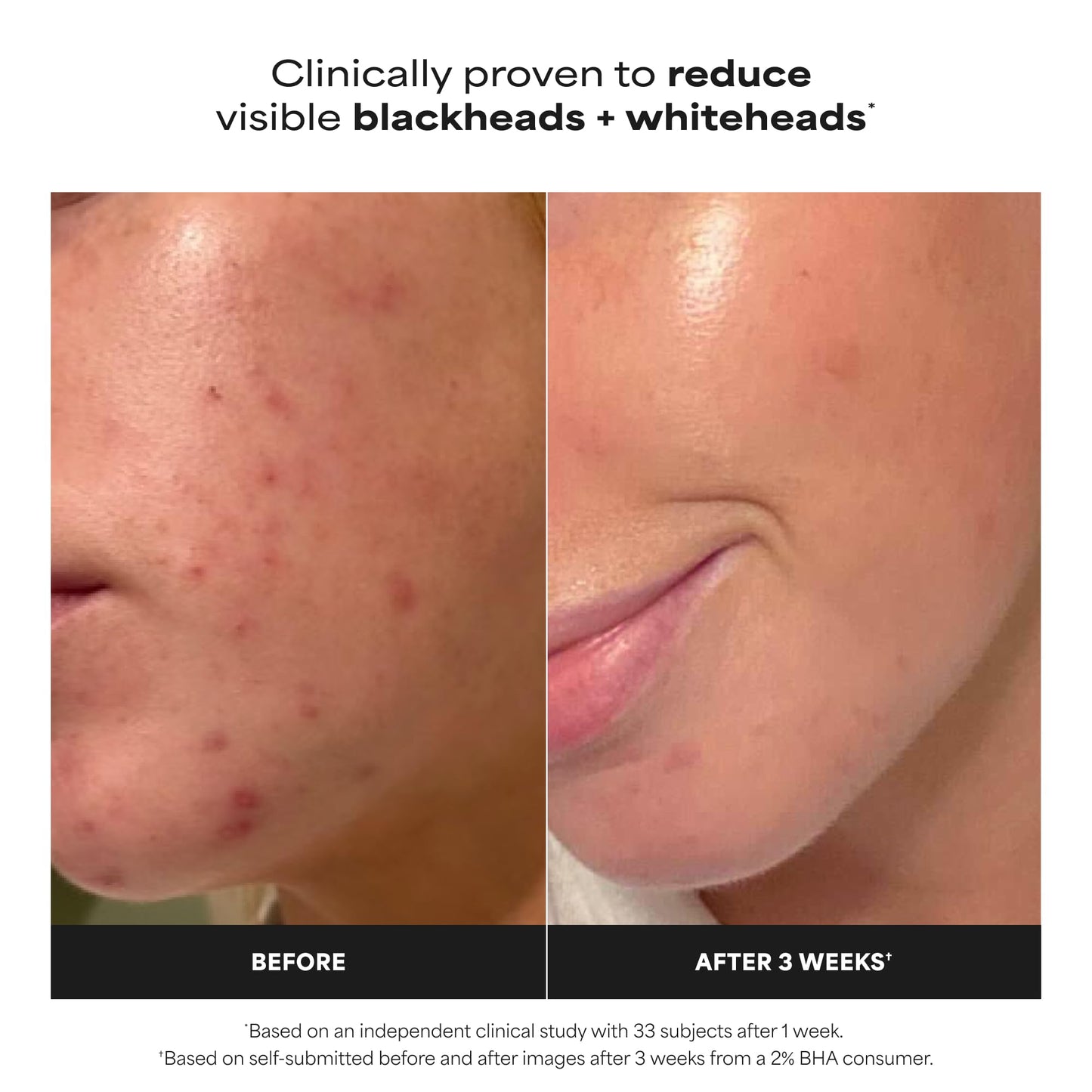 Paula's Choice Skin Perfecting 2% BHA Liquid Salicylic Acid Exfoliant, Gentle Facial Exfoliator for Blackheads, Large Pores, Wrinkles & Fine Lines, Travel Size, 1 Fluid Ounce