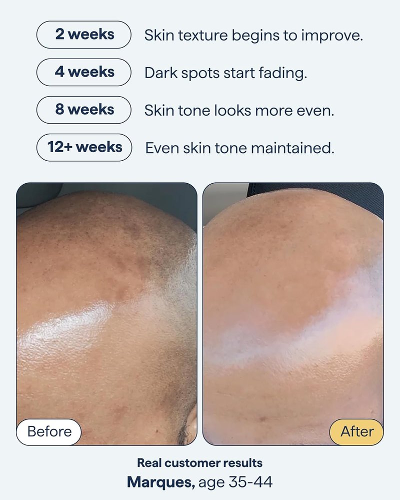 Advanced Discoloration Correcting Serum - Dark Spot Remedy with Retinol & Kojic Acid | Fragrance-Free, 1fl oz