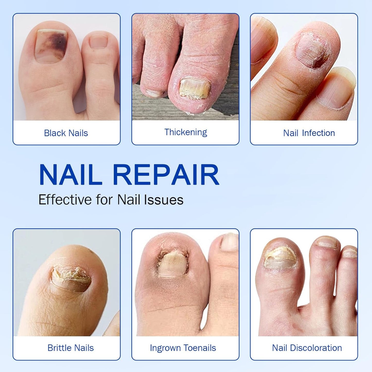 Fungal Nail Patches - Extra Strength Hydrogel Treatment for Fast Repair | 21 PCS, Overnight Care for Damaged Nails