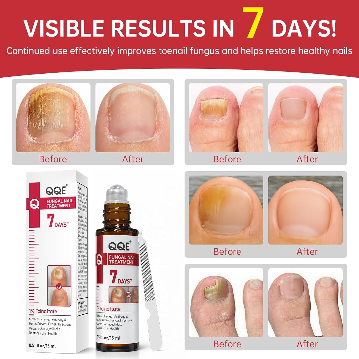 Nail Fungus Treatment - Extra Strength 1% Tolnaftate | Plant-Based Formula for Thickened Nails, 0.51 fl. oz.