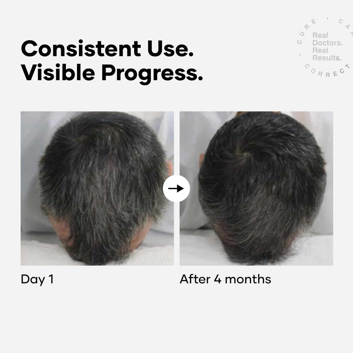 Anti Gray Hair Serum - Gradually Restore Natural Hair Color in 4 Months | Peptide-52 | 1.01 Fl Oz (Pack of 2)