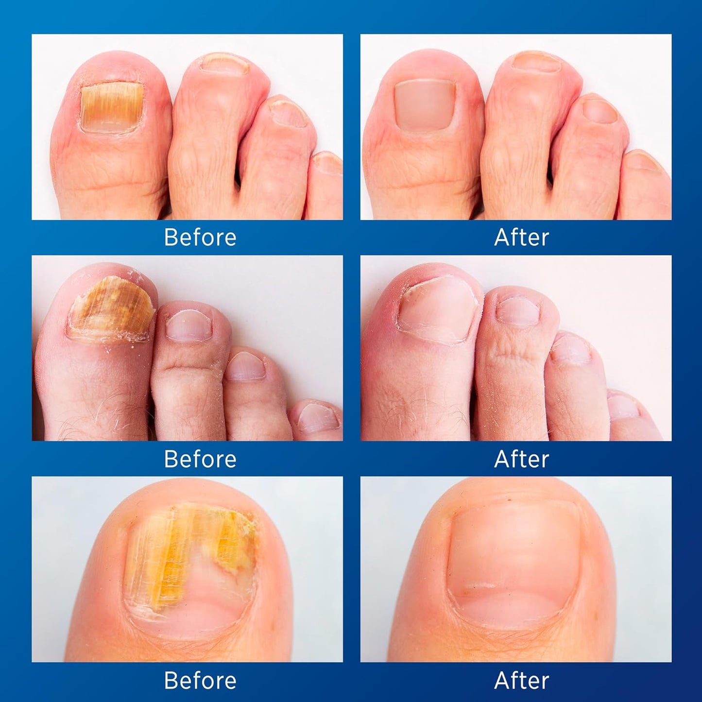 Toenail Fungus Treatment - Extra Strength Liquid & Nighttime Patches | 32 Patches + 15ml Set