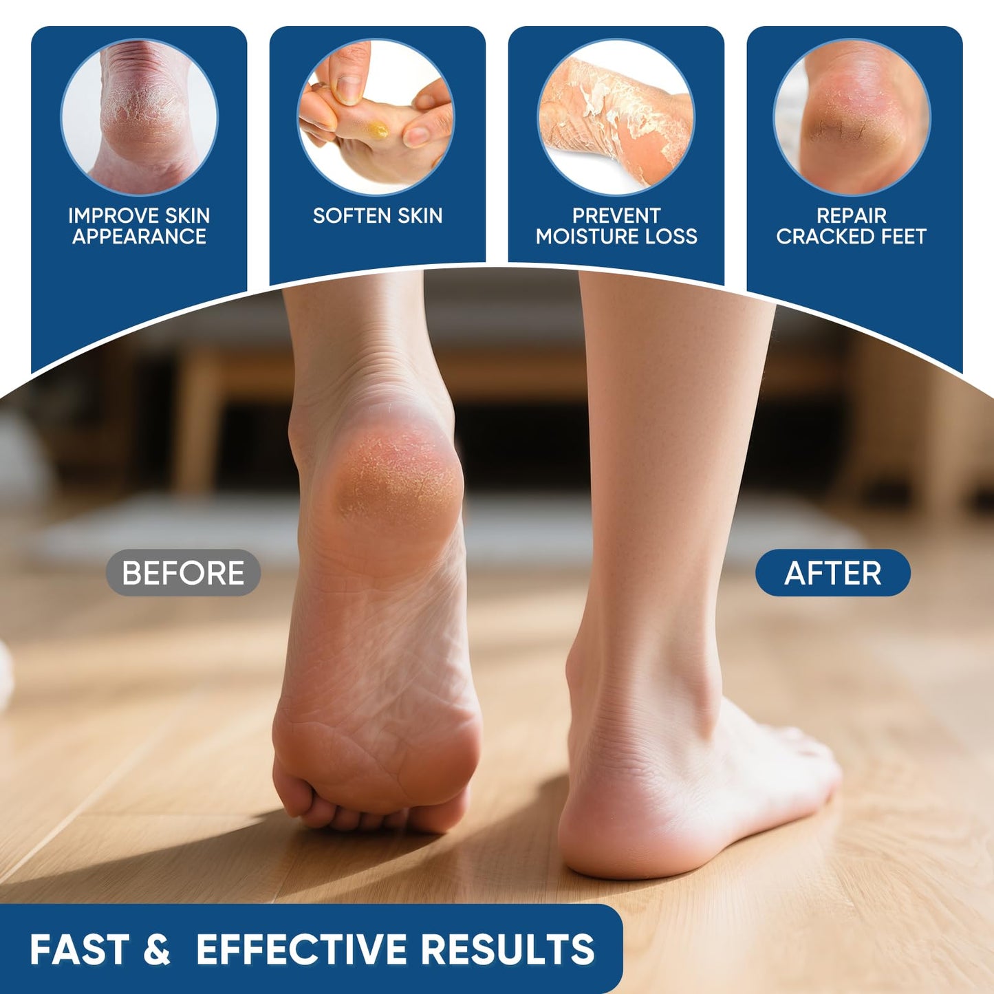 VREKEF Urea Cream 40 Percent with 2% Salicylic Acid, Urea Cream 40 Percent for Feet Maximum Strength, Foot & Hand Cream for Dry Cracked Heels, Callus Softener for Rough Thick Skin, 5.29 oz