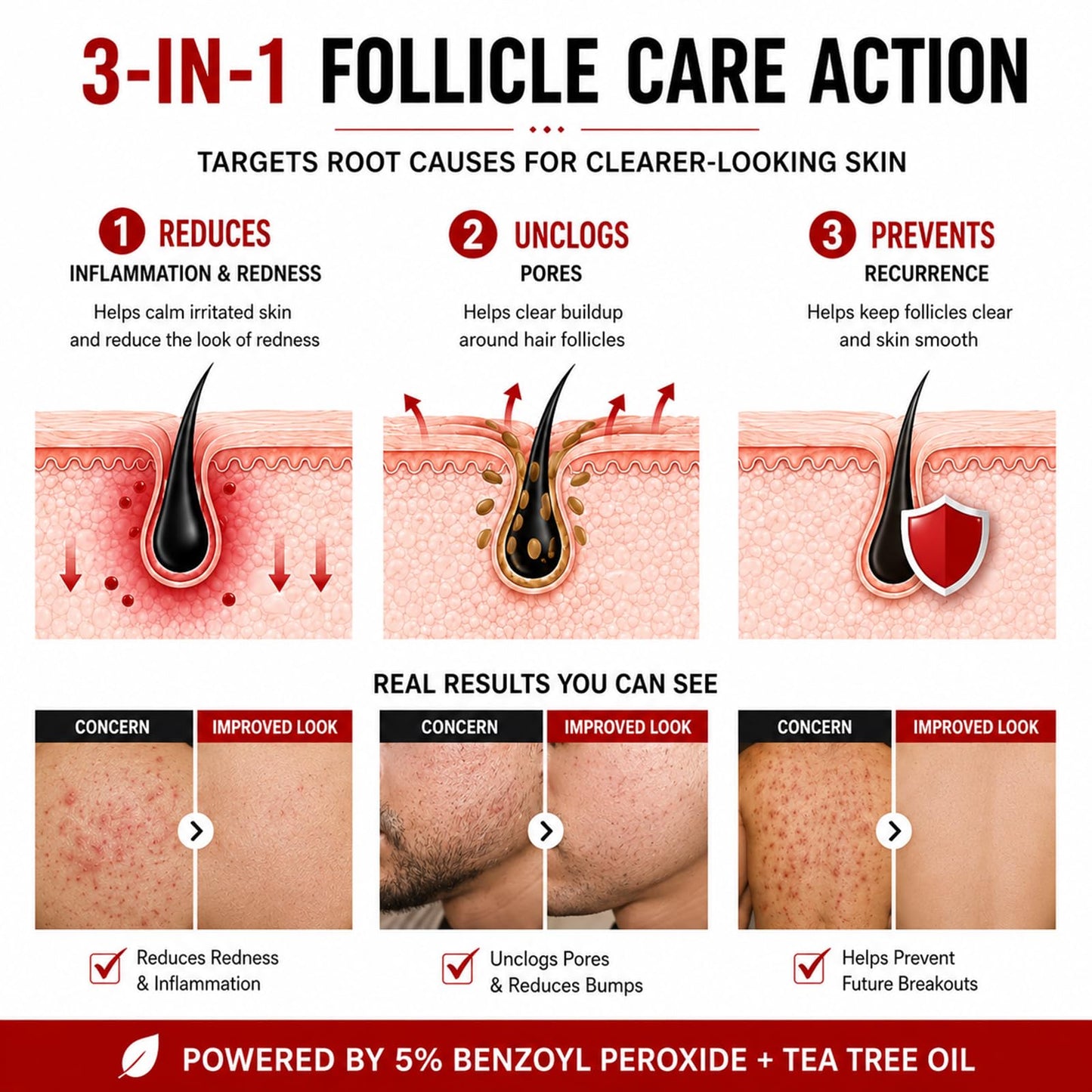 OCSINL Folliculitis Cream 5% Benzoyl Peroxide Scalp Body Care