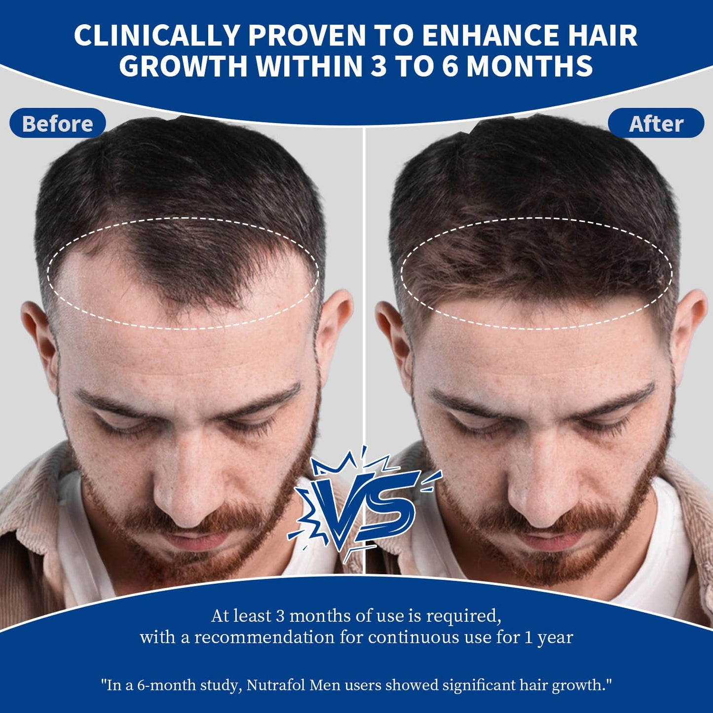 5% Minoxidil Hair Growth Spray 120ml for Men & Women, Thinning Hair Regrowth Treatment with Rosemary Extract, Fast Absorbing Non-Greasy Scalp Solution, Easy Spray for Beard, Daily Hair Loss Care