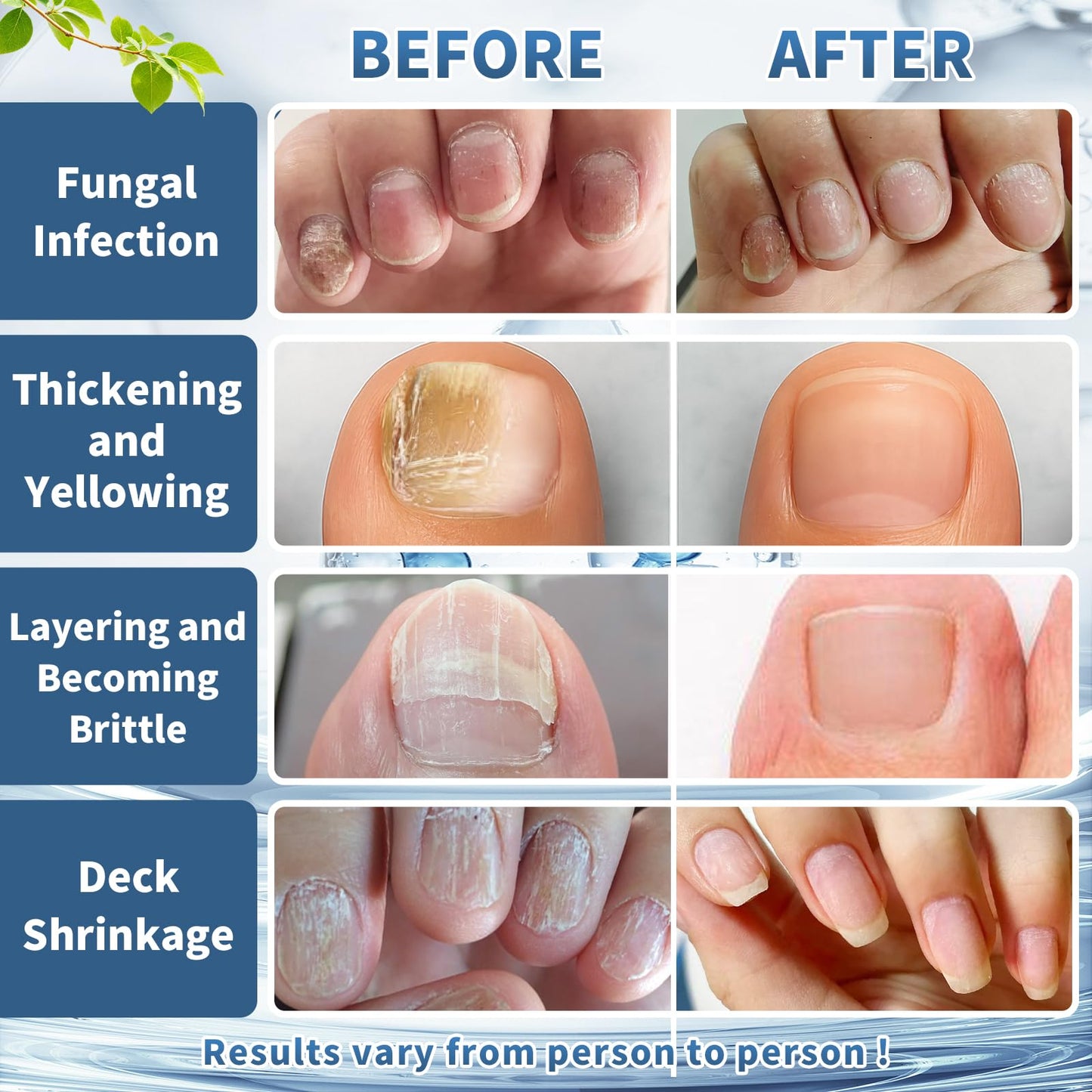 BeamBalm Maximum Strength Nail Fungi Treatment