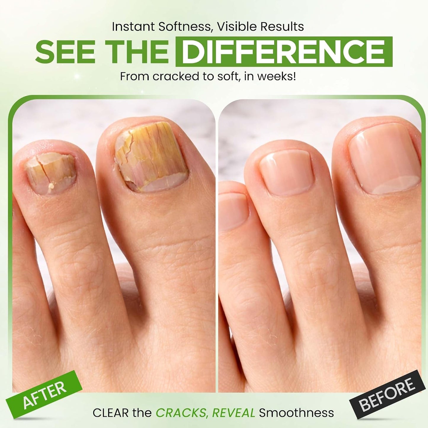 Urea Nail Gel with Tea Tree Oil | Softens & Repairs Nails - Night Time Formula for Fast Results