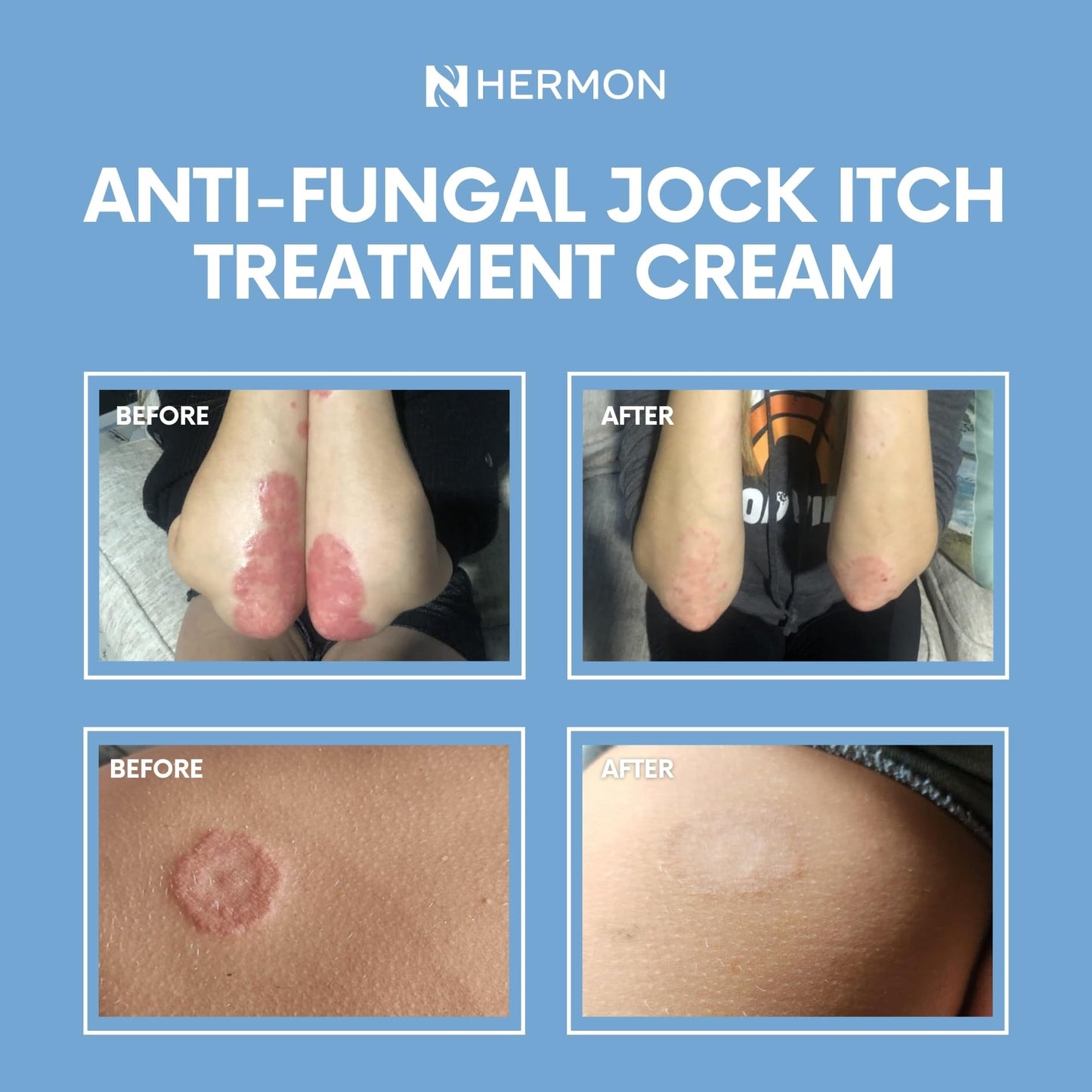 Hermon Jock Itch Antifungal Cream, Ringworm Treatment for Humans, Ringworm Cream for Humans, Foot & Body Balm, Provides Soothing Relief-1.05oz