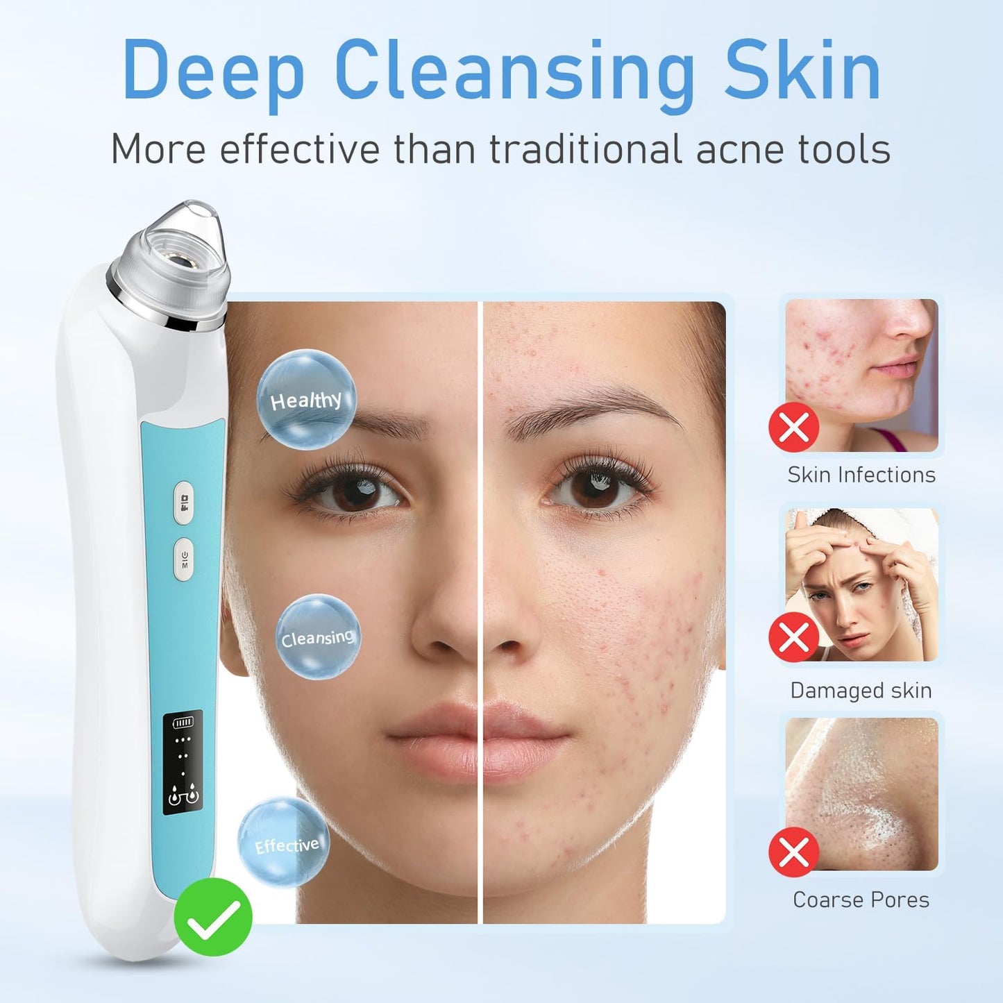 Facial Pore Blackhead Remover Vacuum, 1080P Camera Blackhead Remover, 20x Zoom, 8 LEDs ＆ 3 Suction Modes, 800mAh Battery & USB - 6 Heads Pore Cleaner Kit for Women&Men(Blue)