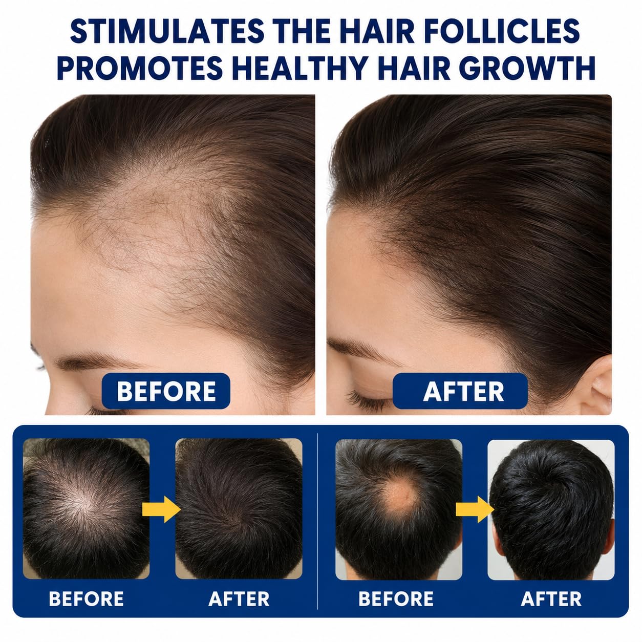 Alopecia Hair Growth Cream with Biotin & Rosemary Oil | Anti Hair Loss Treatment for Thicker Fuller Hair, Scalp Nourishing Butter for Thinning Hair, Intensive Hair Densifying Essence for Men & Women