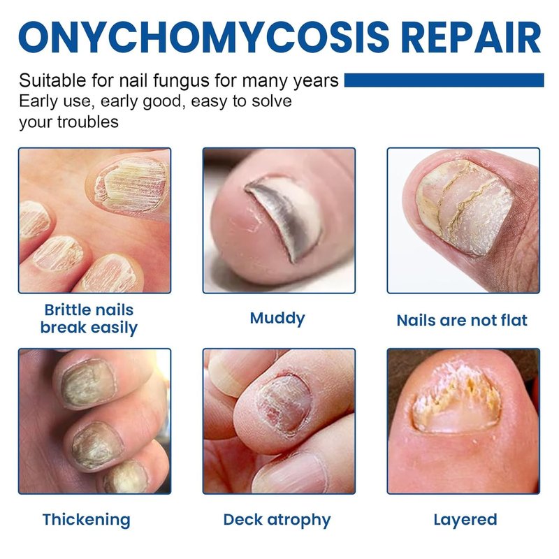 Toenail Fungus Treatment - Extra Strength Hydrogel Nail Repair Patches | 60 Pcs for Fast Renewal