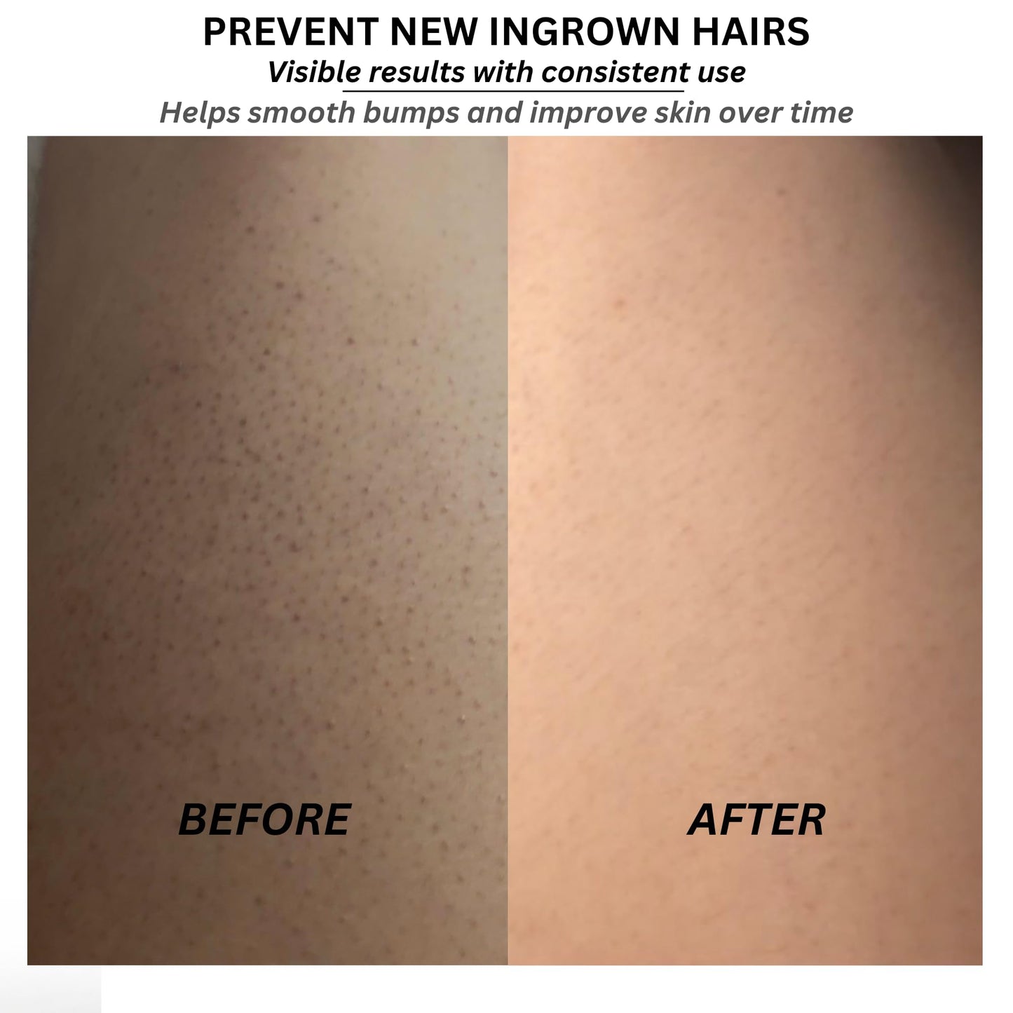 Pearl Ex Ingrown Hair Serum for Smooth Skin – Liquid Exfoliant for Razor Bumps, Dark Spots & Ingrowns – No Scrub Formula – Vegan, Fragrance Free, No Harsh Chemicals – 1 oz