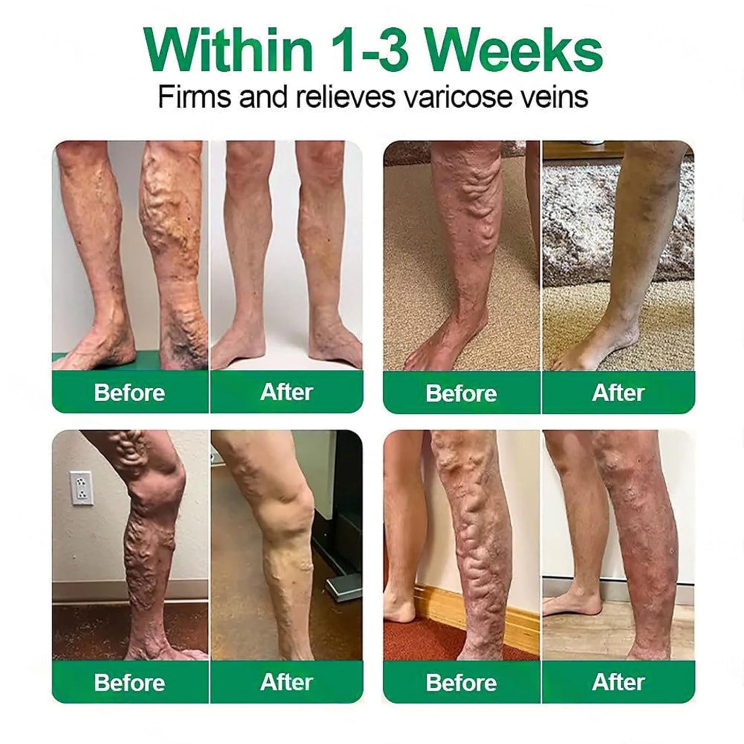 Healrize Vein Target Microdarts Patch - Natural Varicose Vein Treatment for All Skin Types | 2 Boxes
