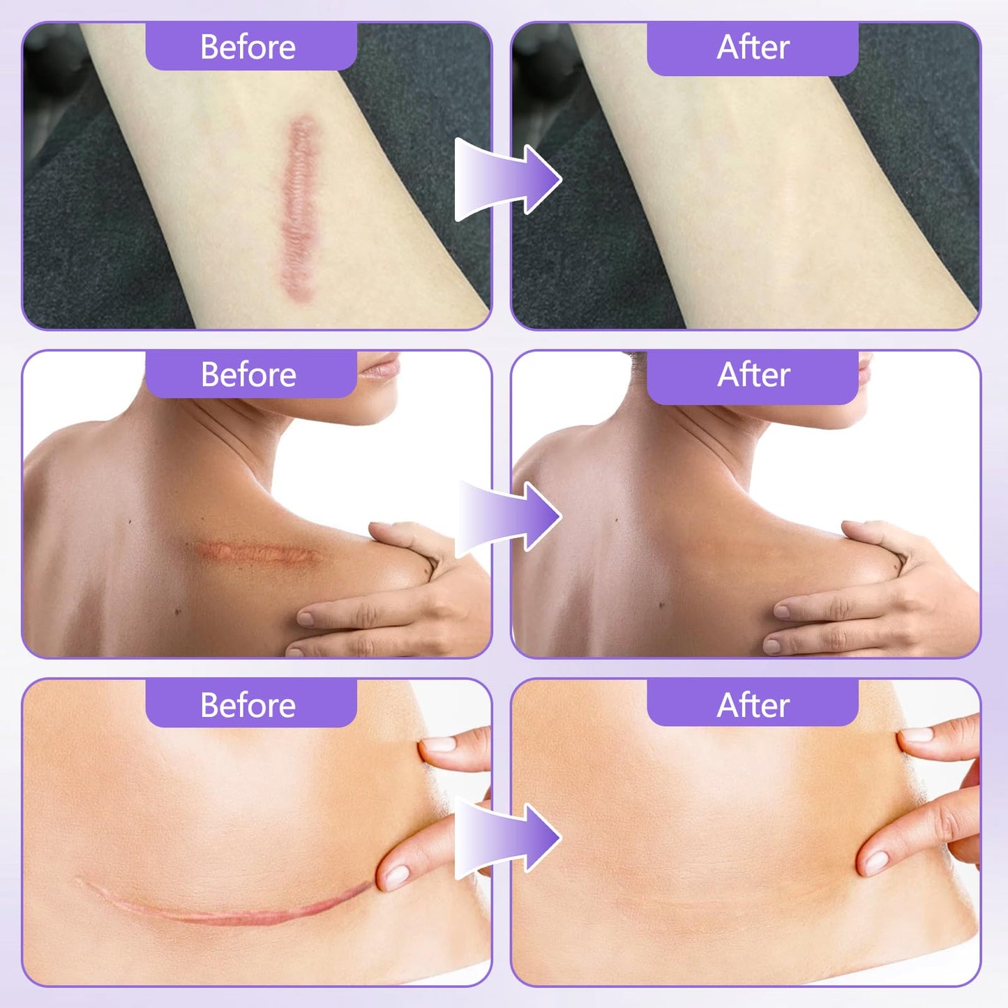 Silicone Collagen Scar Tape, Collagen Sheets for Scars & Wrinkle, Silicone Scar Removal Strips for Various Different Scars and Wrinkles, Old & New Scars for All Ages (1.6In * 60In)