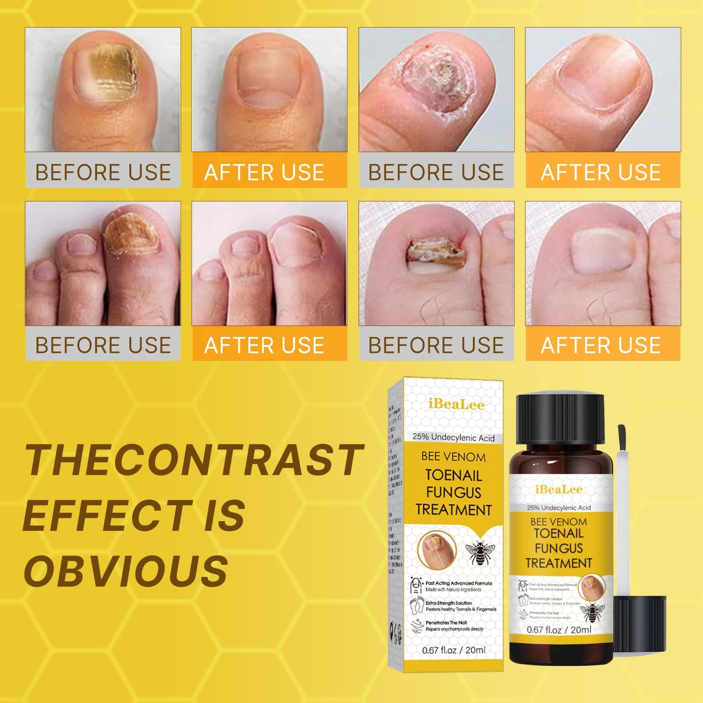 Bee Venom Antifungal Solution Extra Strength - Targets Fungal Concerns on Toenails & Fingernails, Helps Restore Yellow & Ingrown Nails, Foot Care Essentials