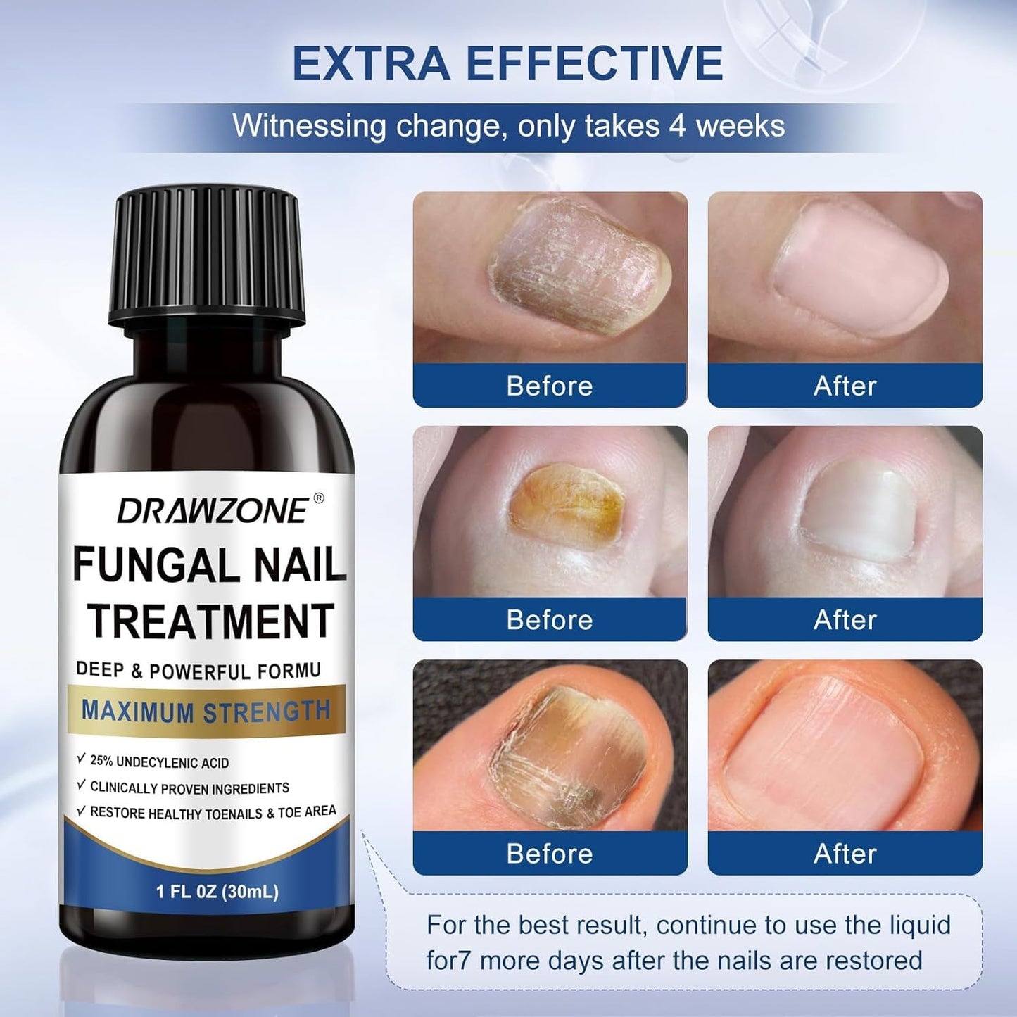 Toenail Fungus Treatment Extra Strength with 25% Undecylenic Acid, Ingrown toenail treatment, nail repair, Fungus nail treatment, yellow toenail, Damaged Nails foot fungus treatment extra strength