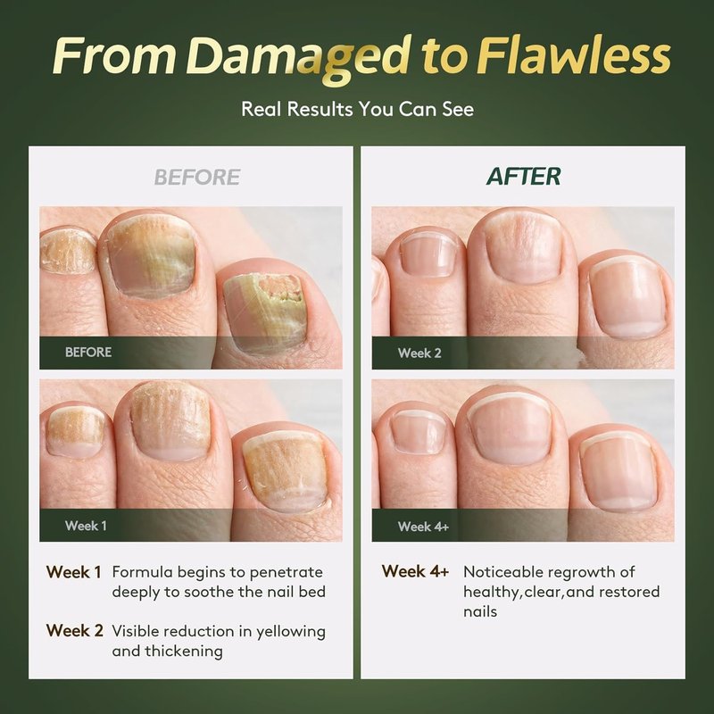 Toenail Fungus Treatment Extra Strength【Max Strength Tea Tree Oil & Undecylenic Acid】Fungus Nail Treatment Liquid Maximum Strength【3-Day Fast Relief】Antifungal Foot & Toe Nail Repair Drops