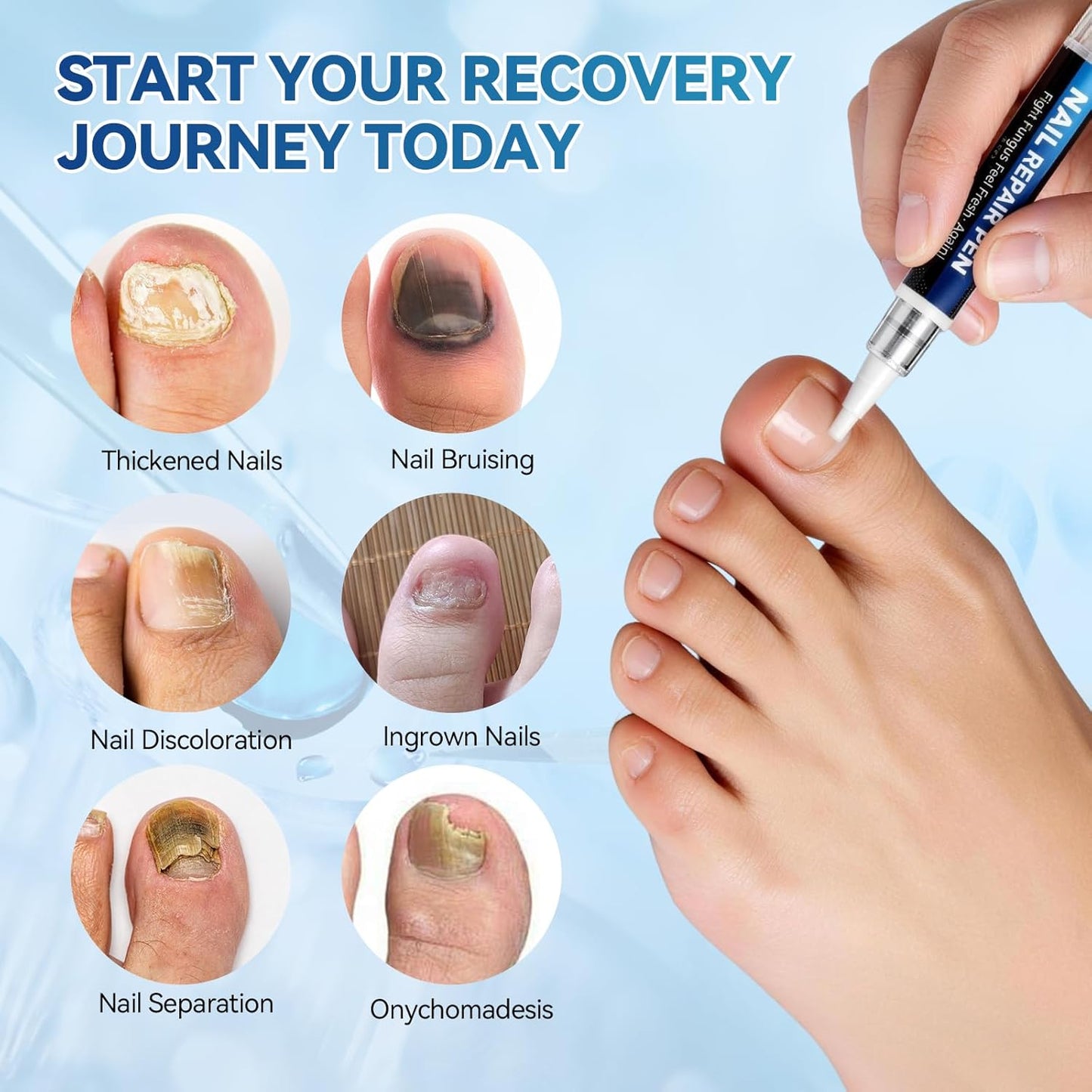 Nail Fungus Treatment Pen - 25% Undecylenic Acid for Toenail Repair | 5 Count, 5ml/0.18FL OZ