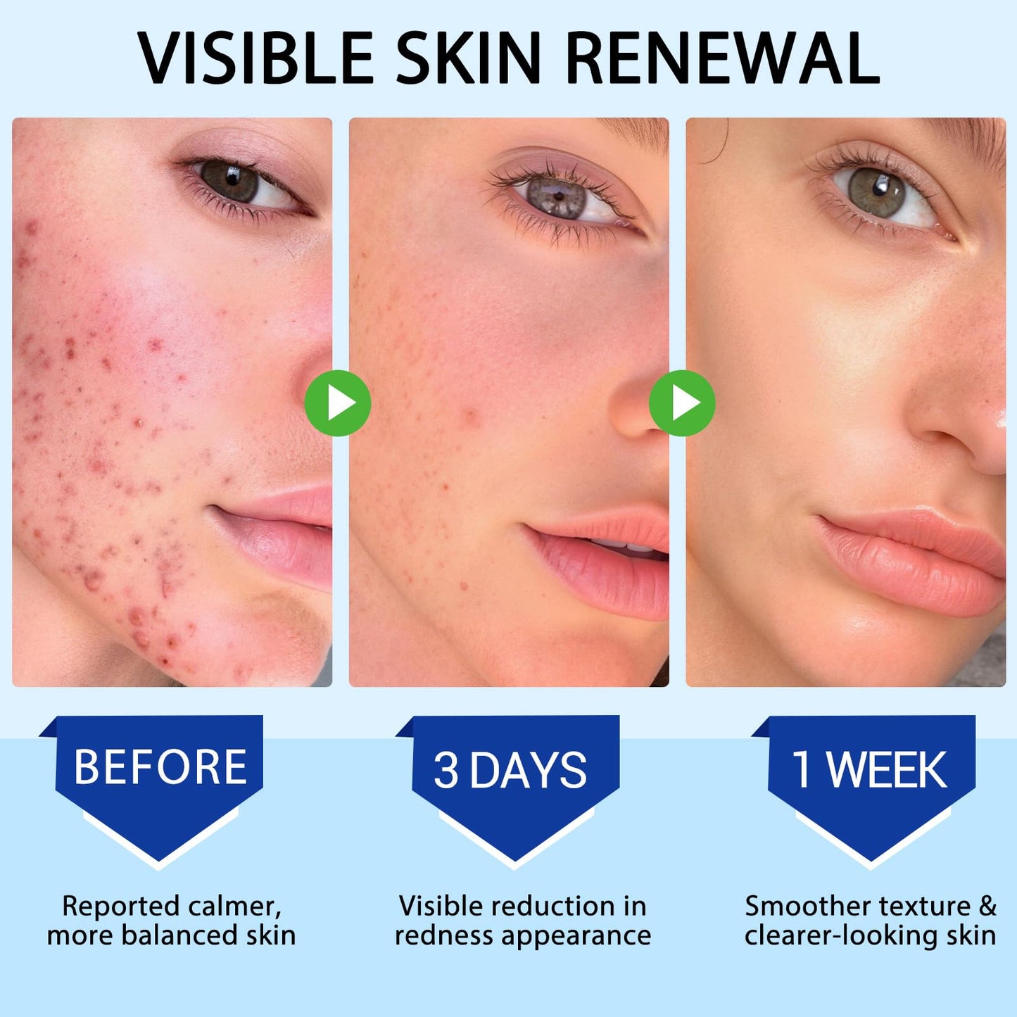 Folliculitis & Acne Treatment Cream Salicylic Acid & Herbal Extracts for Scalp, Face, Body & Back Soothes Redness, Itch & Irritated Skin-120g