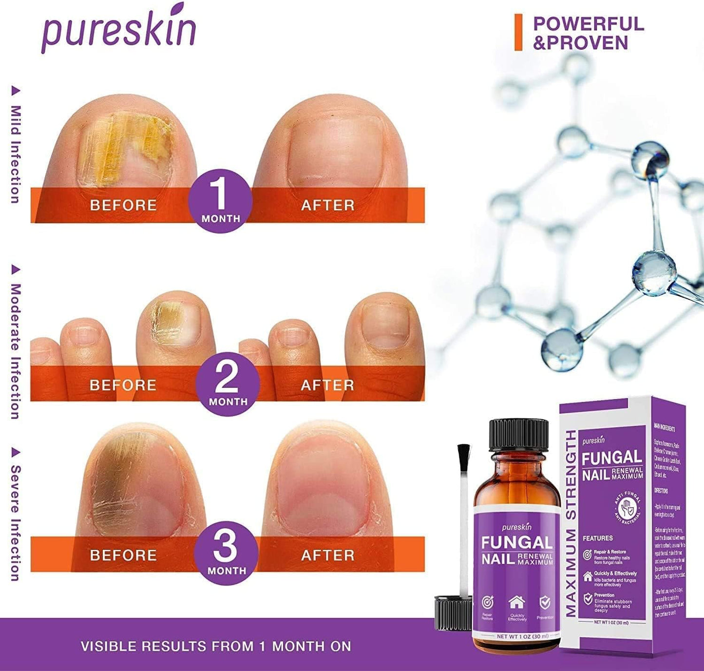 Toenail Fungus Treatment Kit - Extra Strength Fungal Nail Renewal with 25% Undecylenic Acid | 1 Oz Nail Repair Liquid & File