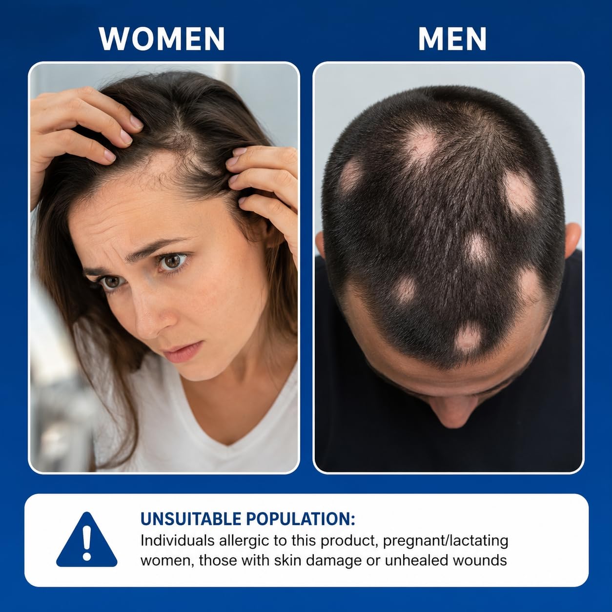 Alopecia Hair Growth Cream with Biotin & Rosemary Oil | Anti Hair Loss Treatment for Thicker Fuller Hair, Scalp Nourishing Butter for Thinning Hair, Intensive Hair Densifying Essence for Men & Women