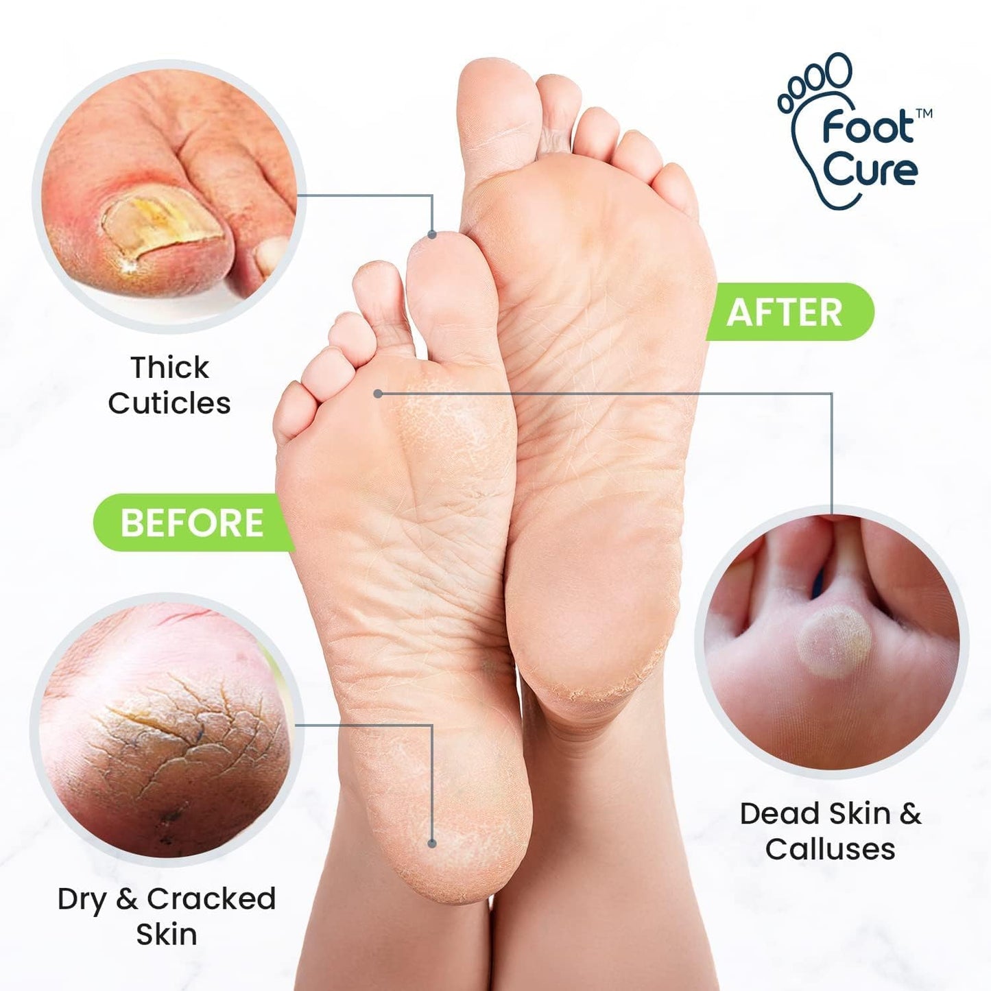 Exfoliating Foot Care Set - Callus Remover & Pedicure Kit with Tea Tree Oil Soak, Urea Cream | 4-Piece Made in USA