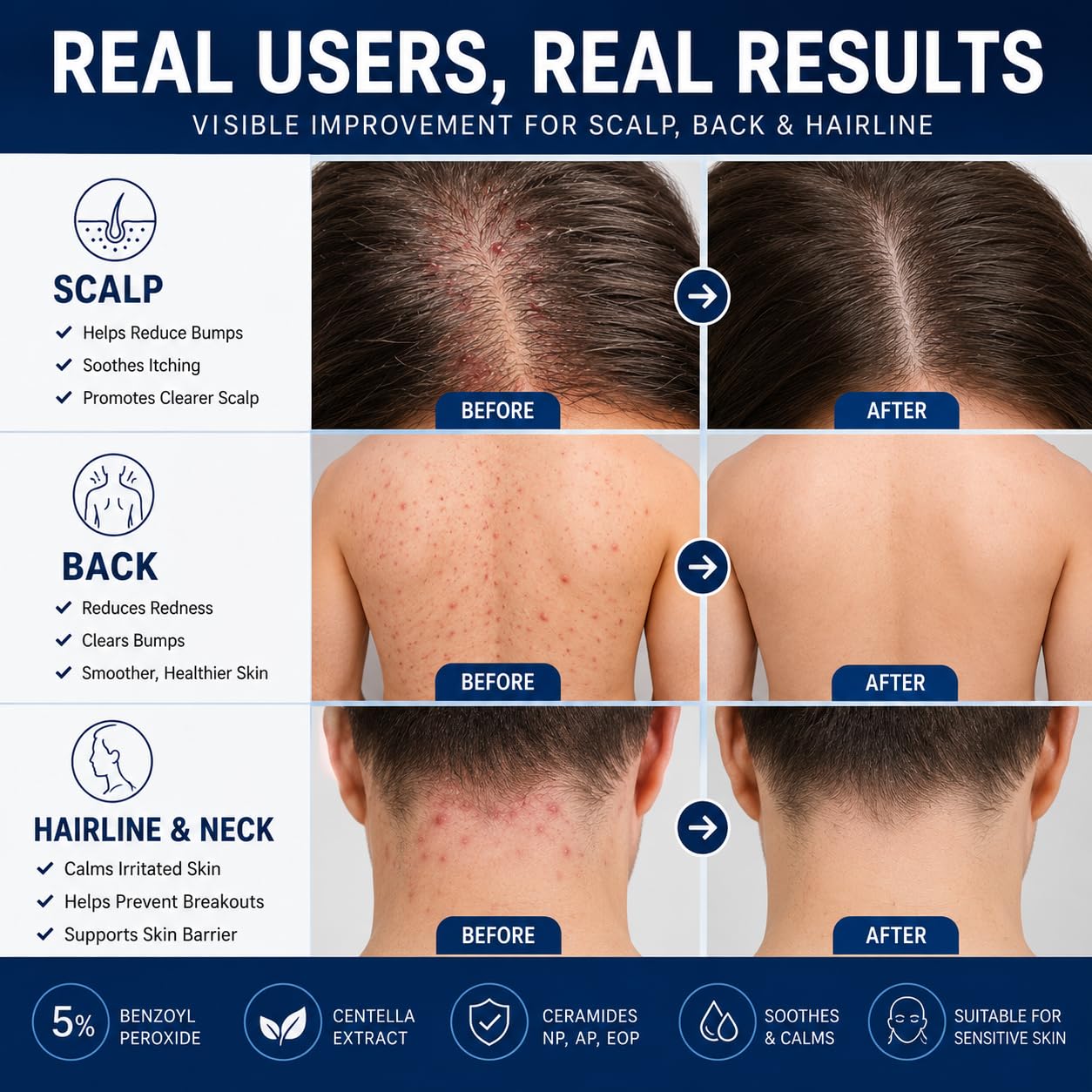 Folliculitis Treatment Cream - 5% Benzoyl Peroxide for Scalp & Body Bumps | Fast Relief for Itching & Redness, 3.53 oz