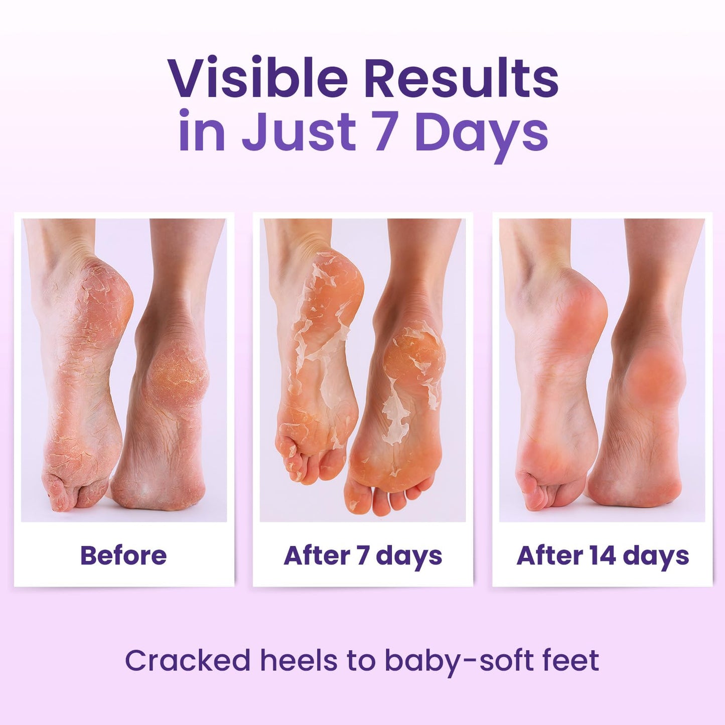 BLOOMORA Foot Peeling Mask (6 pairs) Exfoliating Foot Mask for Dry Cracked Feet with Lavender & Shea Butter, Dead Skin & Callus Remover for Feet, Exfoliating Socks for Women & Men, One Size Fits Most