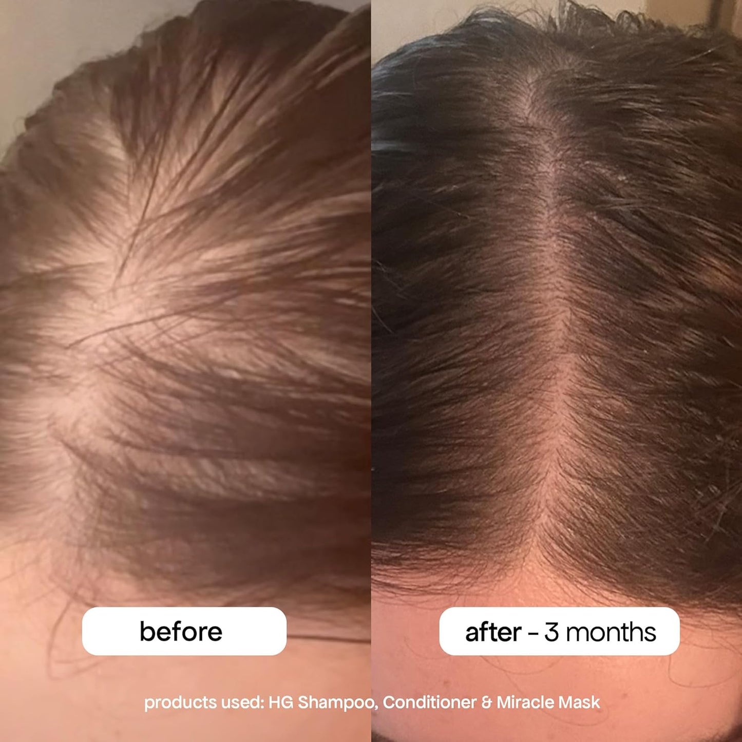 BondiBoost HG Anti-Thinning Shampoo & Conditioner Set - Clinically Tested for Fuller, Thicker Hair | 16.90 fl oz Each