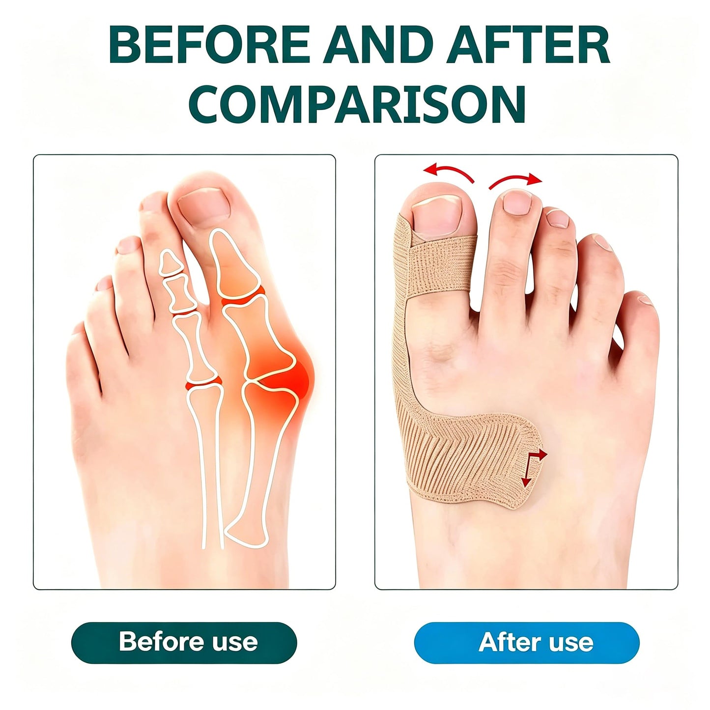 Pre-Cut Bunion Self-Adhesive Hallux Valgus Corrector