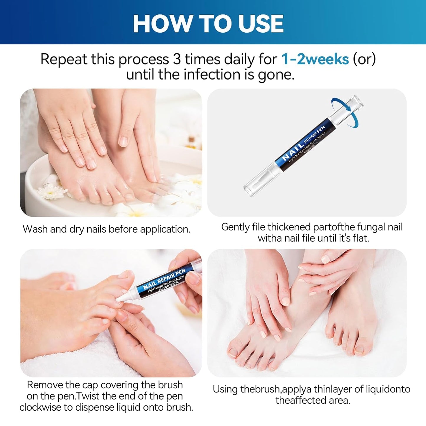 Nail Fungus Treatment Pen - 25% Undecylenic Acid for Toenail Repair | 5 Count, 5ml/0.18FL OZ