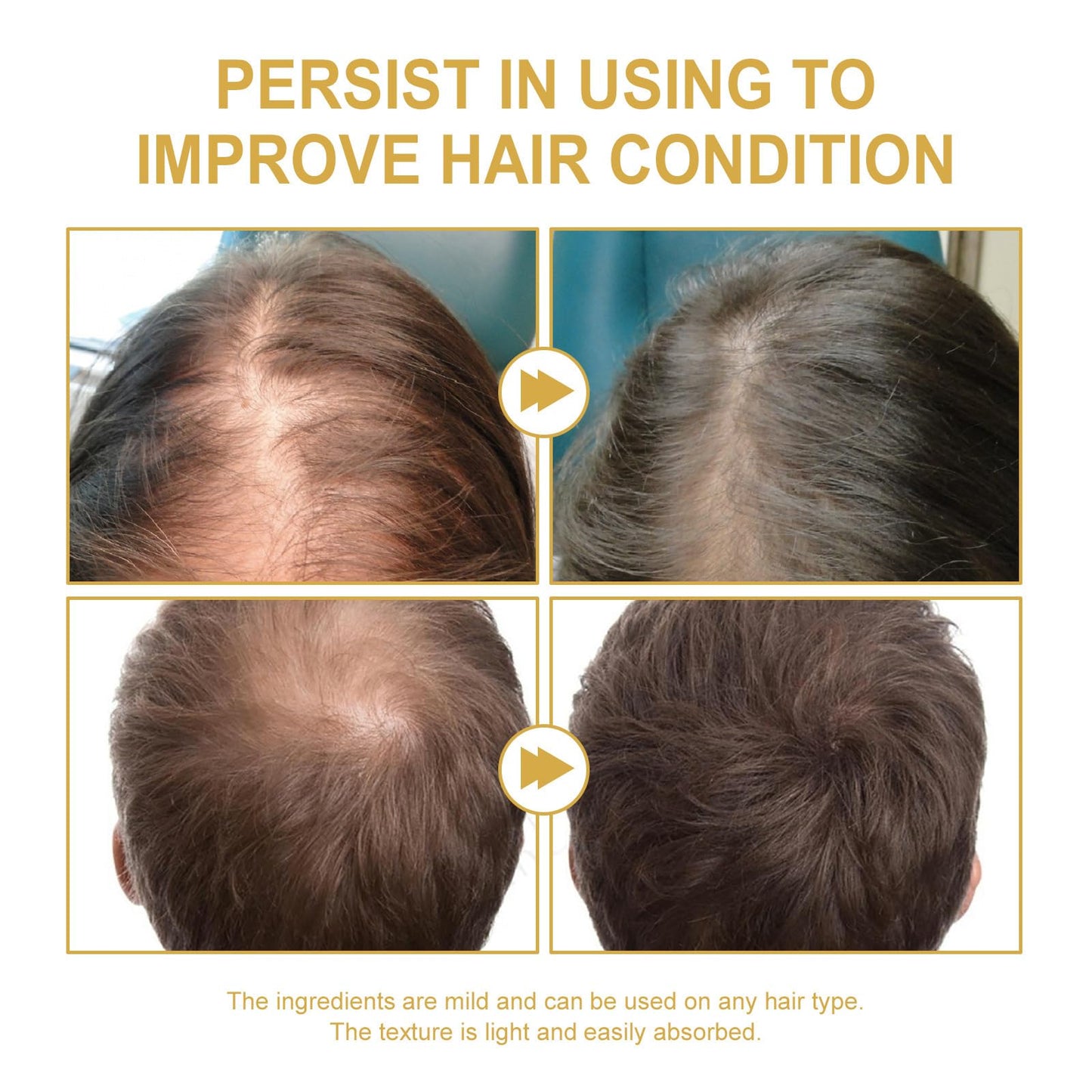 180 ML EELHOE Hair Growth Oil, Natural Rosemary Hair Growth Oil for Dry Damaged Hair and Growth Thin Hair. (3Pcs)