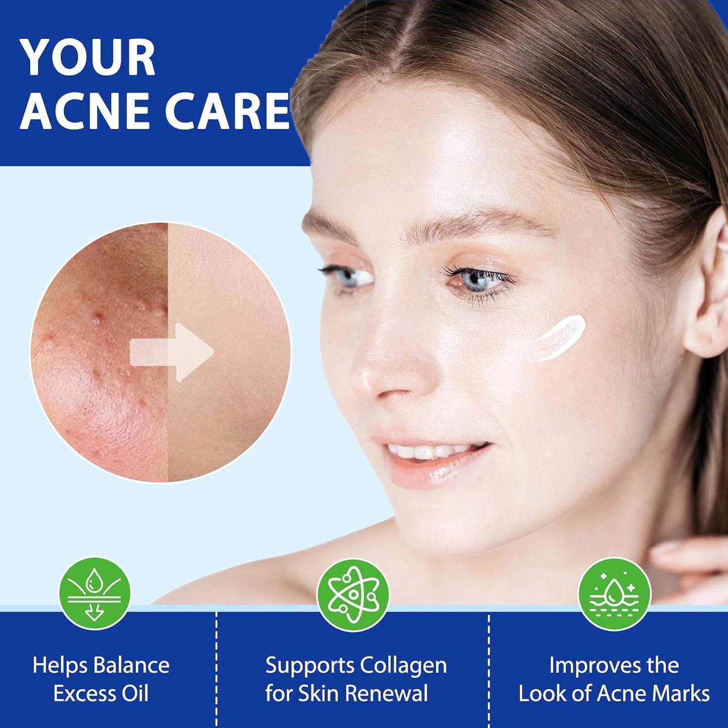 Folliculitis & Acne Cream - Hydrating Formula for Scalp, Face, Body & Butt | Soothes Irritated Skin, 120g