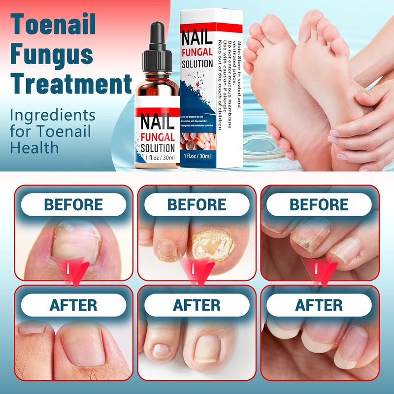 Toenail Fungus Treatment - Extra Strength 25% Undecylenic Acid | Gentle Plant-Based Formula, 1.01 Fl. Oz (Blue)