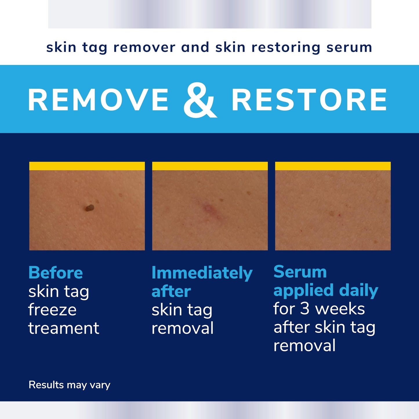Dr. Scholl's Complete Care Skin Tag Remover Kit, 12 ct – Removes Skin Tags in As Little As 1 Treatment, FDA-Cleared & Clinically Proven, Permanent Results, Plus Serum