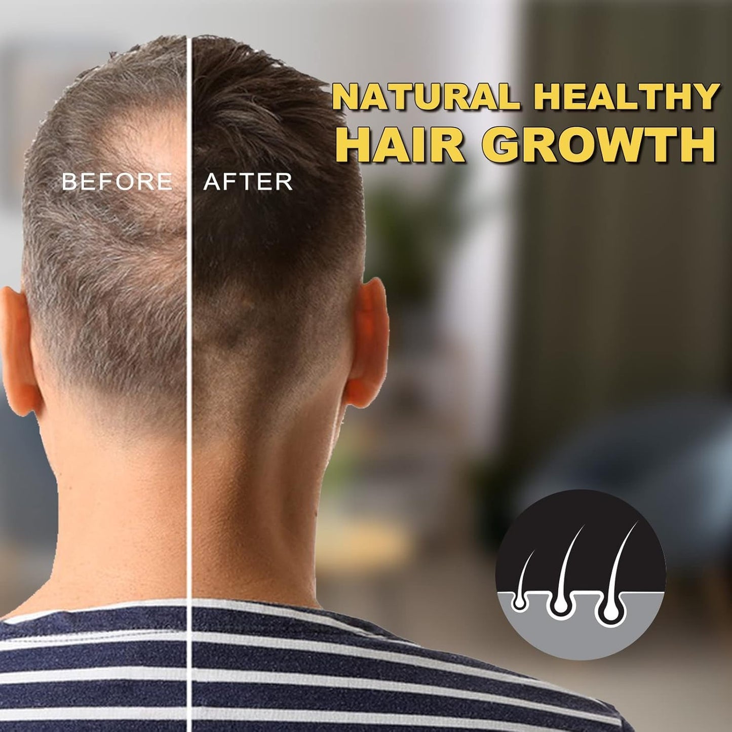 Minoxidil Hair Growth Serum - 5% Formula for Thicker, Stronger Hair | Unisex, 2.02 oz