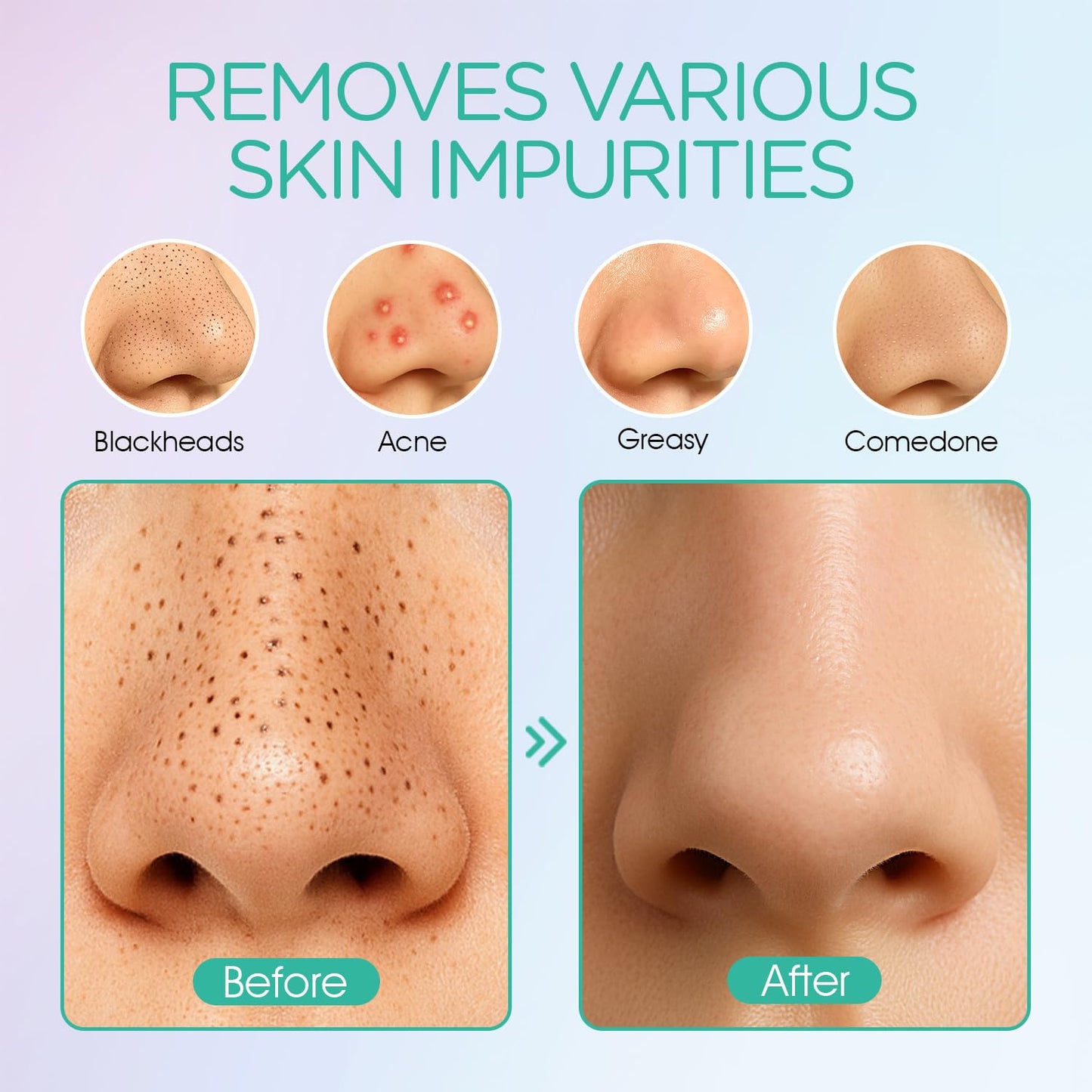 Blackhead Remover Pore Vacuum - Electric Face Cleaner with 6 Suction Heads for Acne & Whitehead Removal