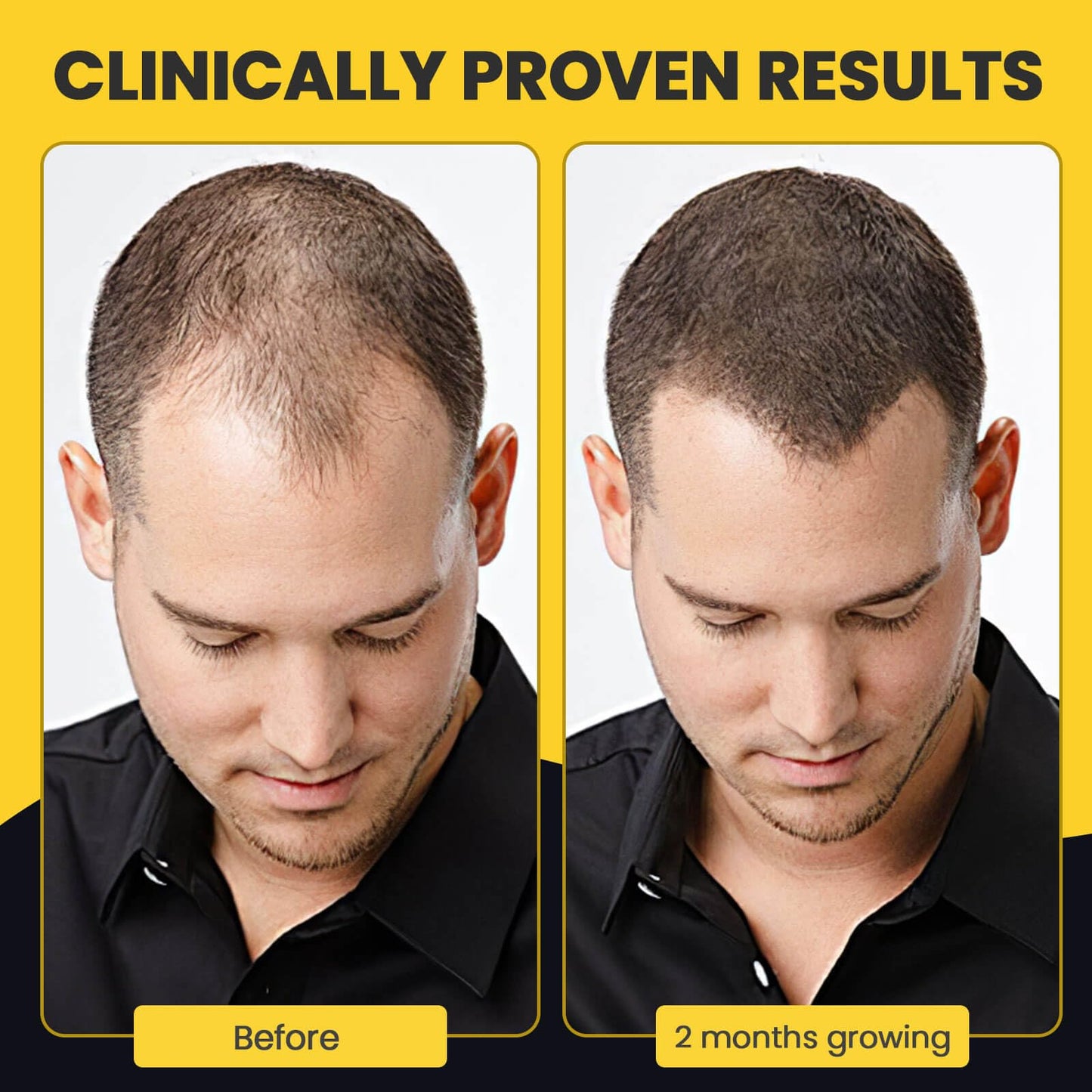 5% Minoxidil for Men and Women Hair Growth with Biotin,Hair Loss Treatments, Unscented Foam, 1 Fl Oz