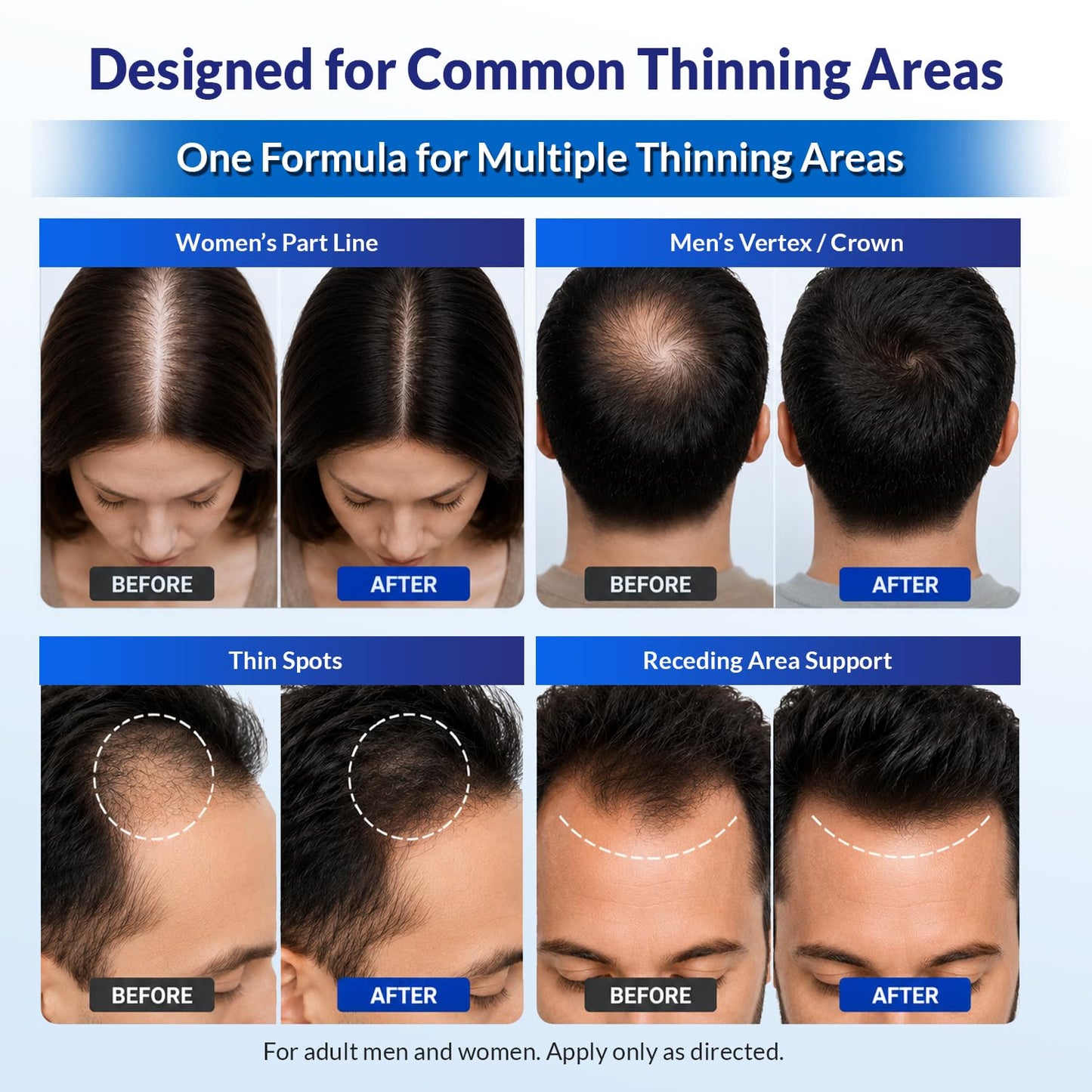 Minoxidil for Men and Women Extra Strength: Minoxidil 5% Topical Solution for Hair Regrowth Treatment for Hair Loss & Thinning Hair - Liquid Formula with Dropper Applicator